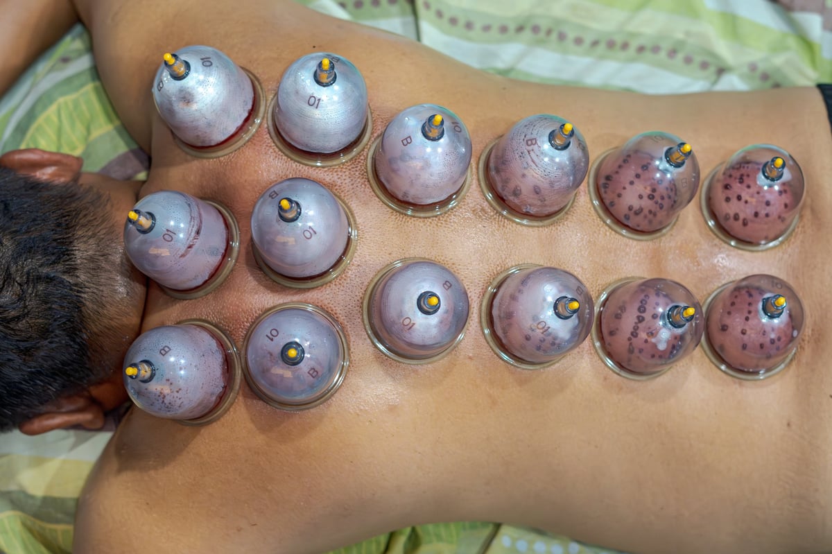 Professionele cupping therapy behandeling