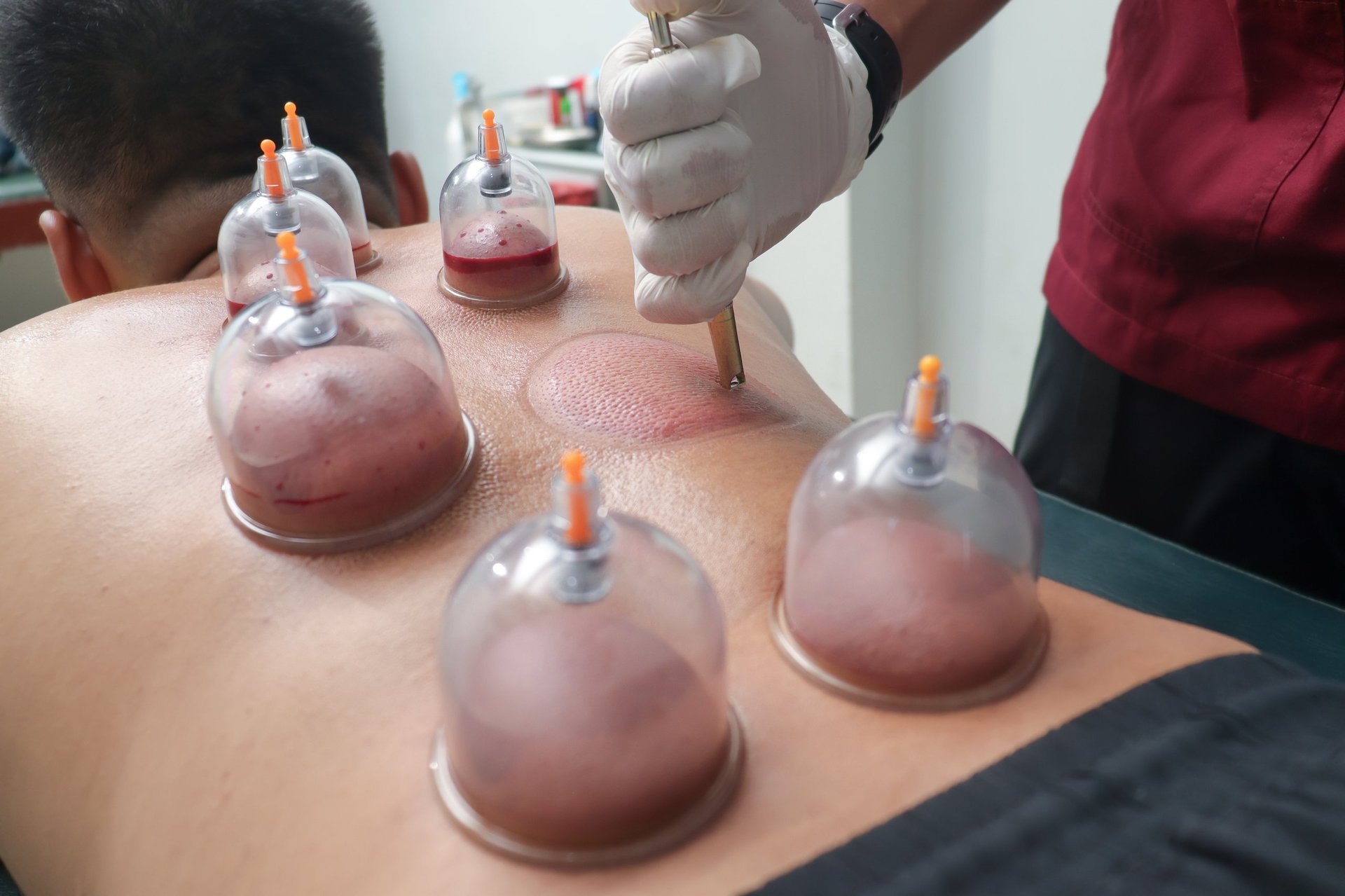 Therapeut voert cupping therapie uit