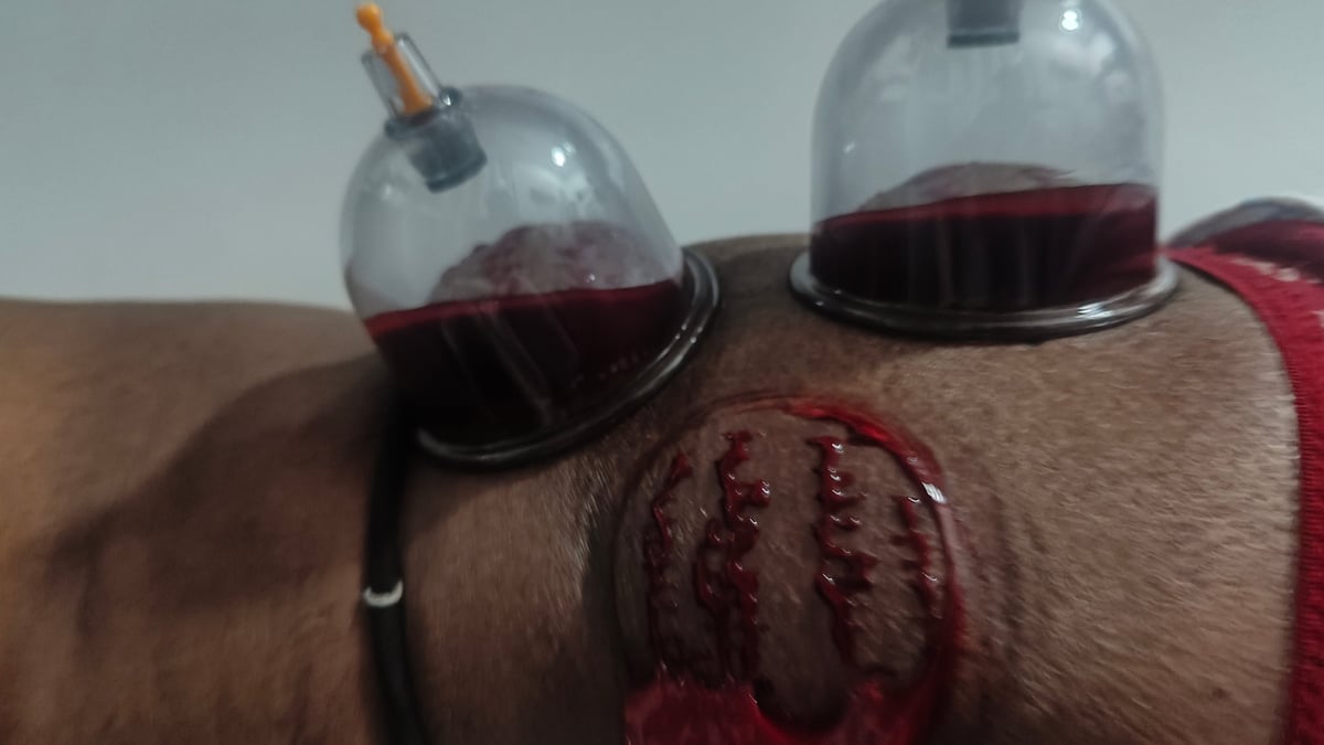 Mannelijke patiënt ontvangt hijama therapie behandeling